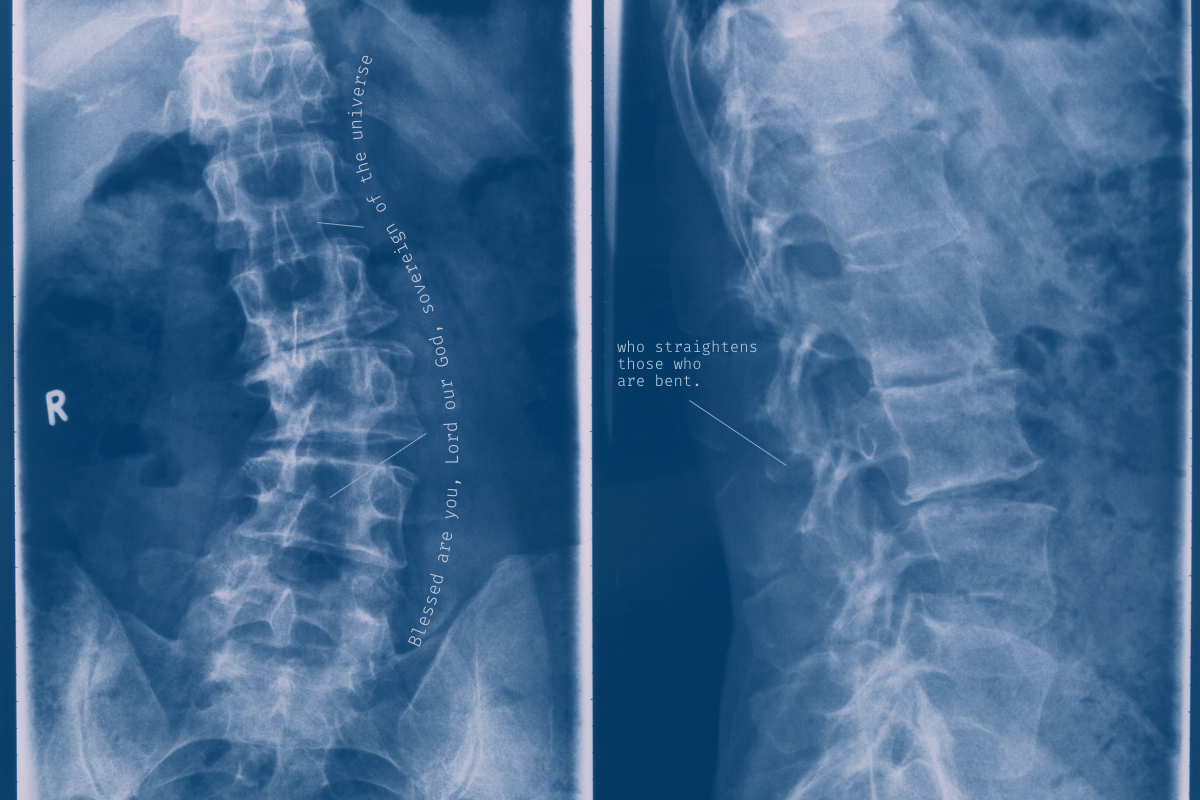 Scoliosis