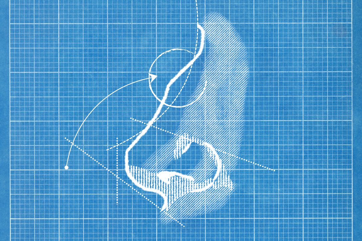 An image of a nose on blue graphing paper. A bump on the bridge of the nose is circled.